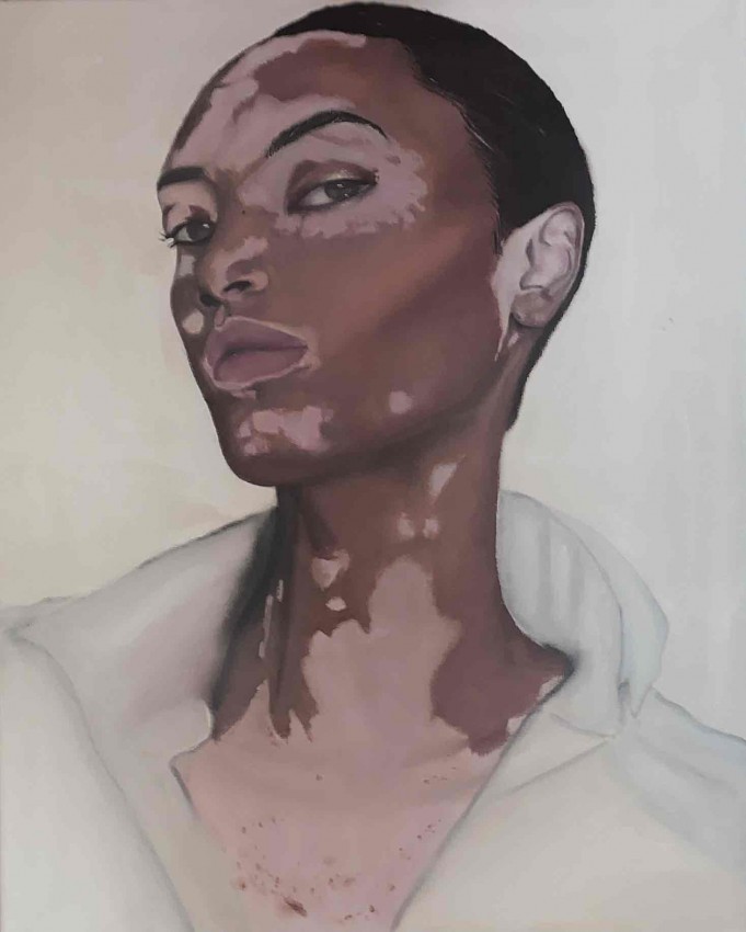 Vitiligo beauty